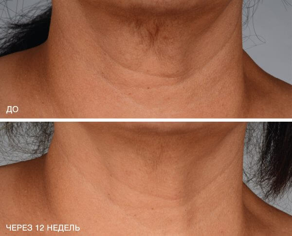 Применение крем is clinical neckperfect complex - до и после